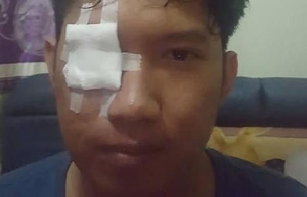Lagi Asyik Motoran, Mata Rendhy Terkena Bara Rokok Pengendara Lain